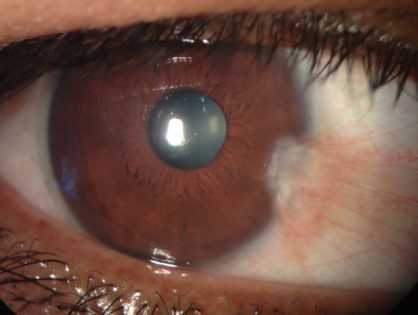 La “carnosidad” en mi ojo crece. ¿Es un tumor maligno?. Sobre el pterigion y tumores