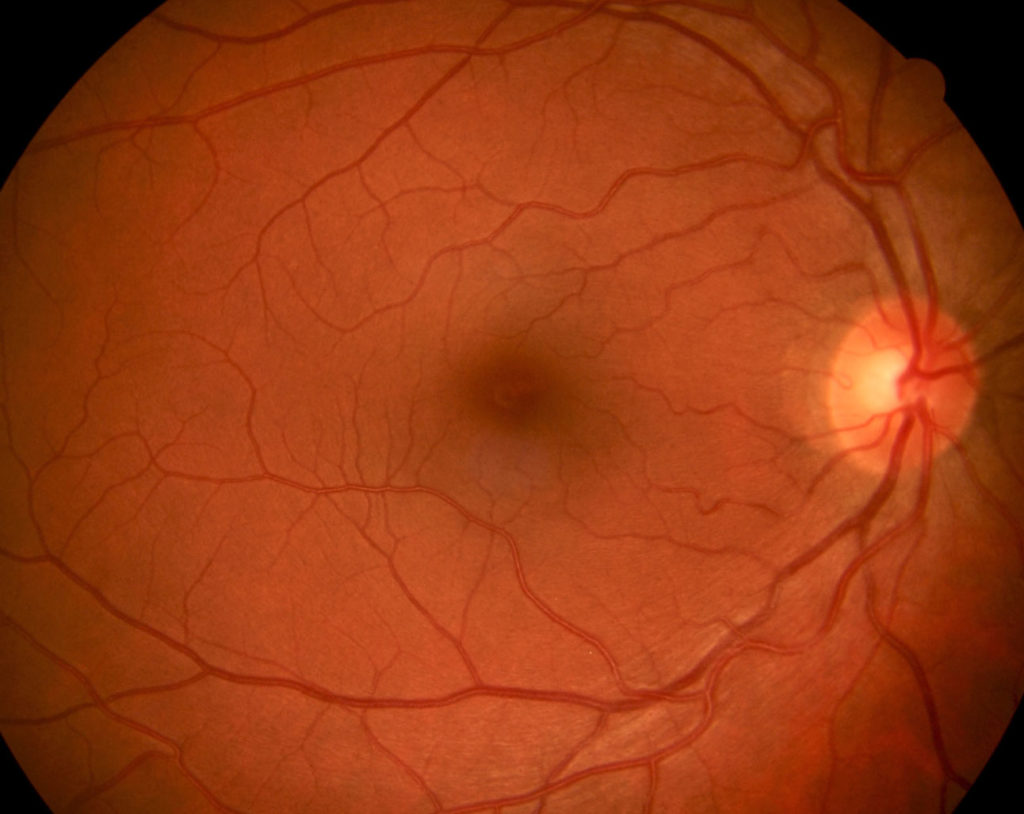 retinografia-1