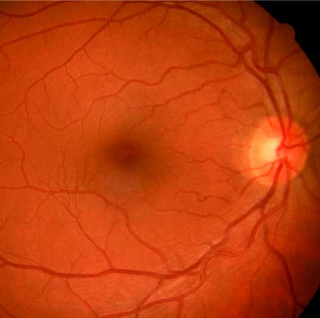 retina-y-macula
