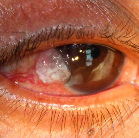 tumores-del-ojo